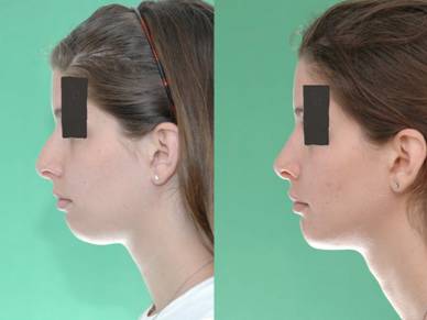 Rhinoplasty with Chin Implant by Dr. Mushtaq