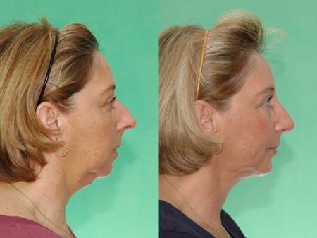 Rhinoplasty with Chin Implant and Head and Neck Liposuction by Dr. Mushtaq