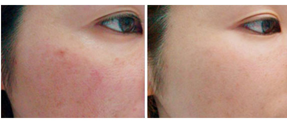 laser-rosacea