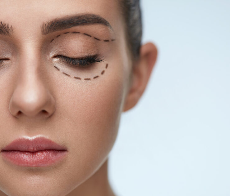 Eyelid Surgery McLean Virginia