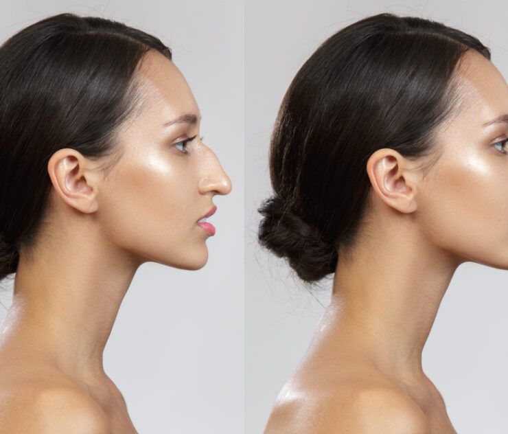 How Much Does Ethnic Rhinoplasty in Virginia Cost?