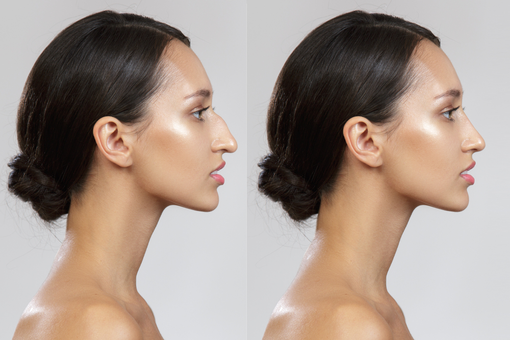 How Much Does Ethnic Rhinoplasty in Virginia Cost?