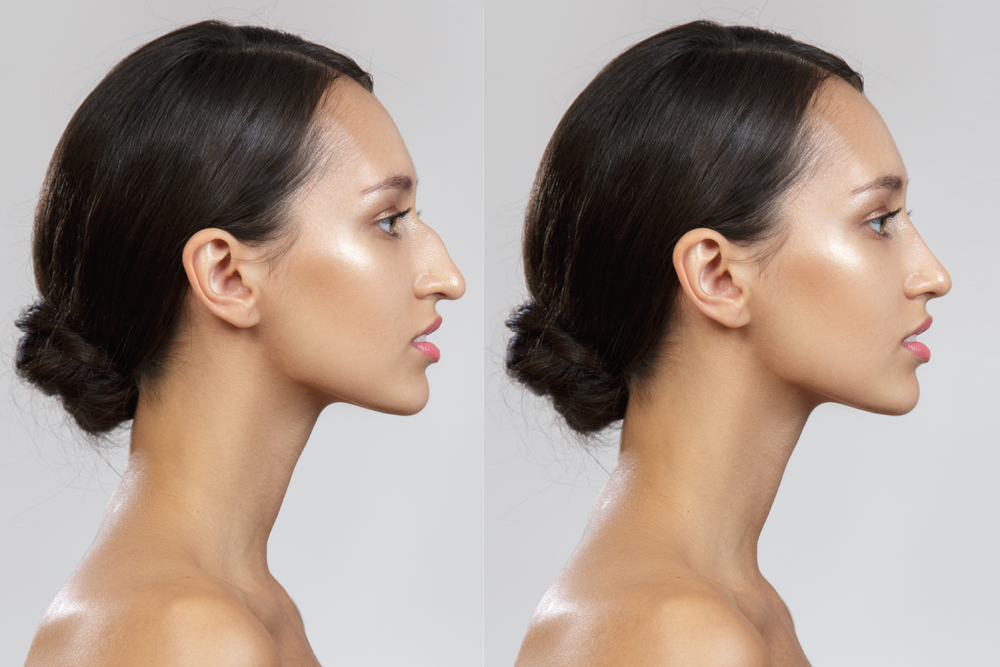 How Much Does Ethnic Rhinoplasty in Virginia Cost? - Top Plastic Surgeon In McLean, VA