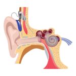 Implantable Hearing Devices