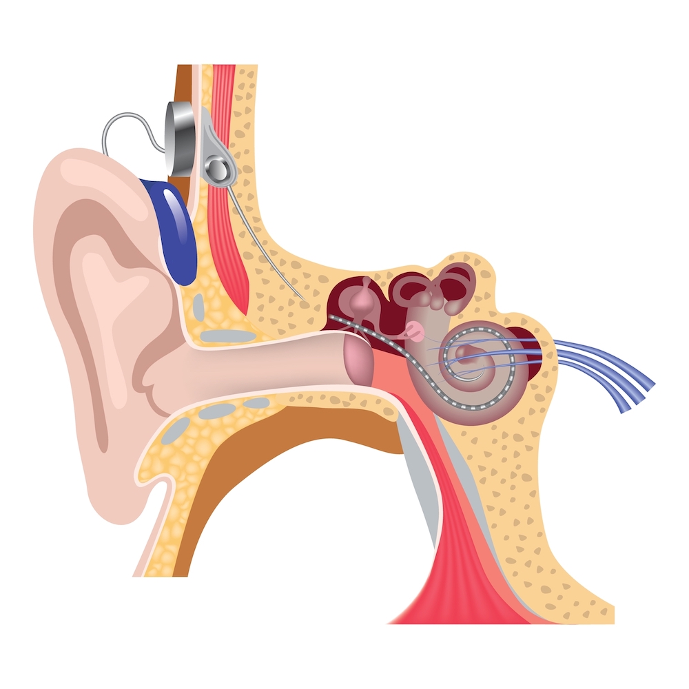Implantable Hearing Devices