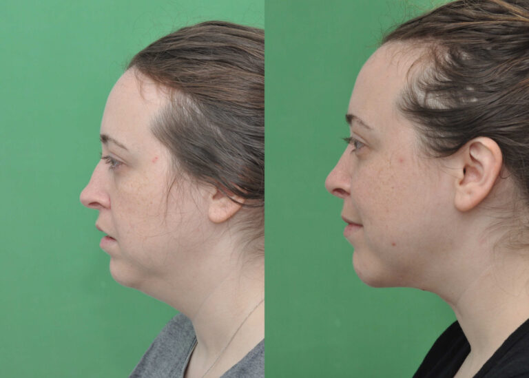 Chin Implant Gallery Top Plastic Surgeon In McLean, VA