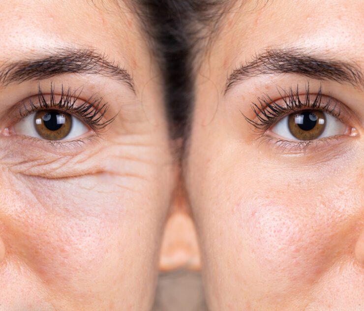 When Can I Wear Contacts After Eyelid Surgery?