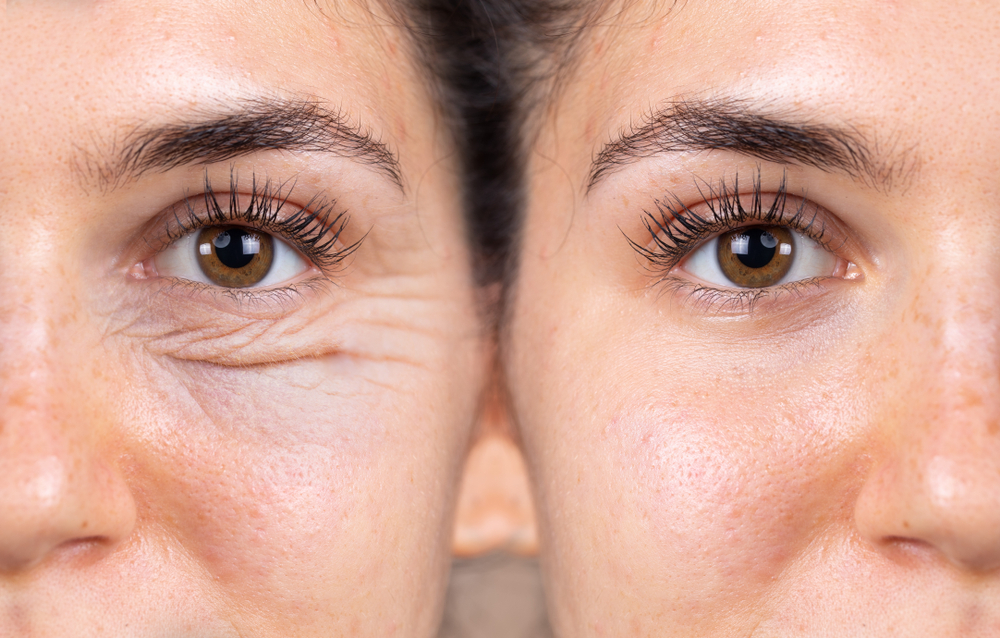 When Can I Wear Contacts After Eyelid Surgery?