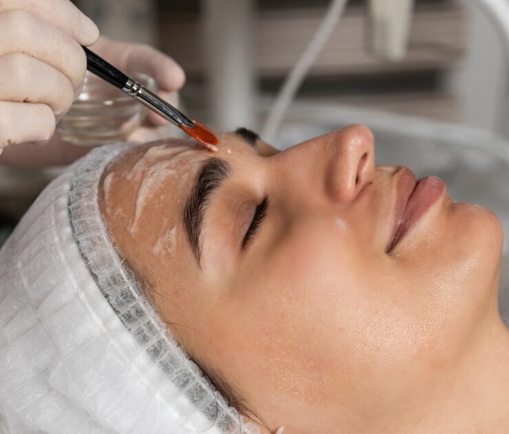 Longer Lasting Chemical Peels for Hyperpigmentation in McLean