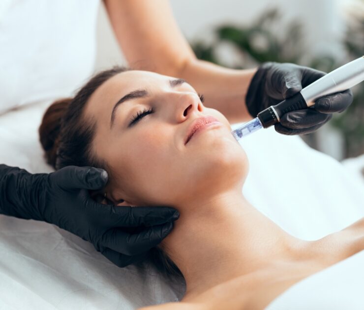 Microneedling in Northern Virginia