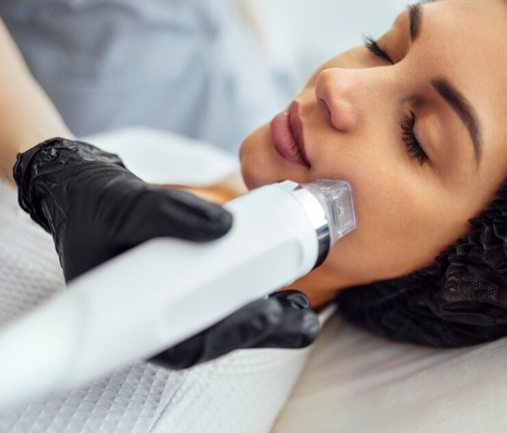 Best RF Microneedling in McLean