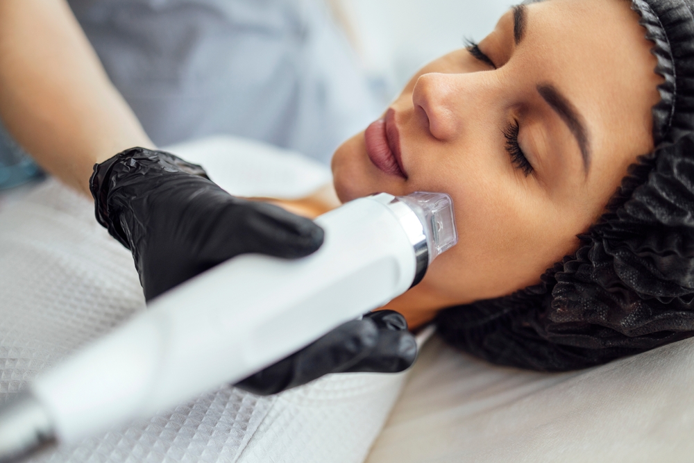 Best RF Microneedling in McLean