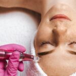 How Painful Is Microneedling and How Long Do Results Last?