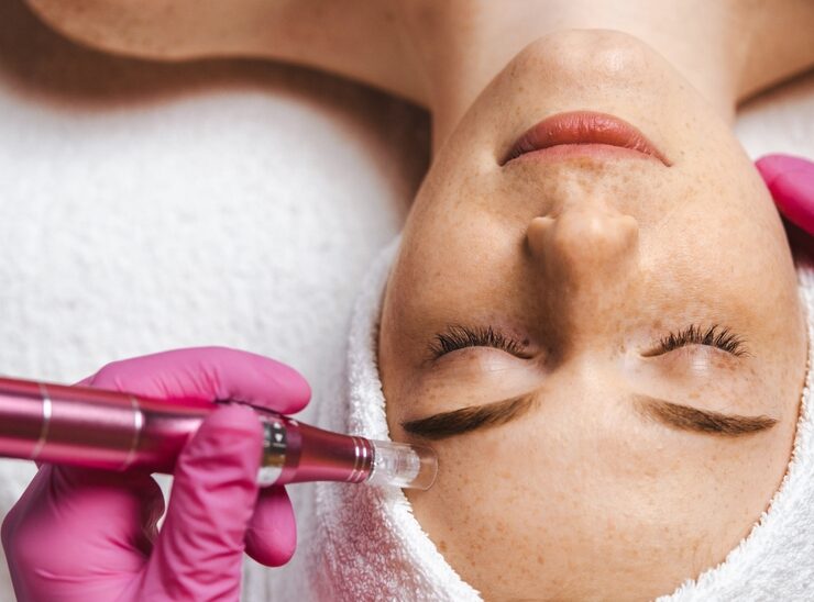 How Painful Is Microneedling and How Long Do Results Last?