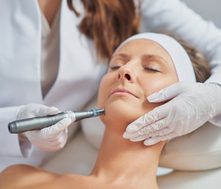 Microneedling Treatments McLean Virginia