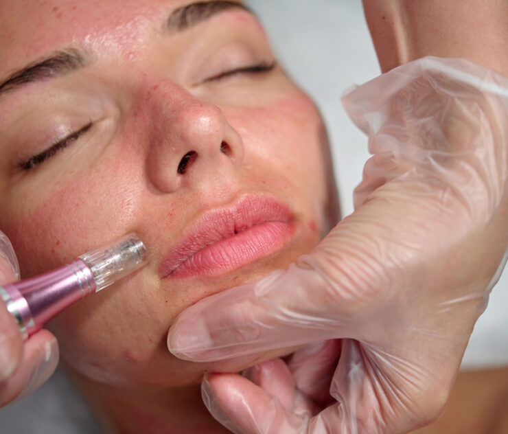 How Long Do Microneedling Treatments Last?