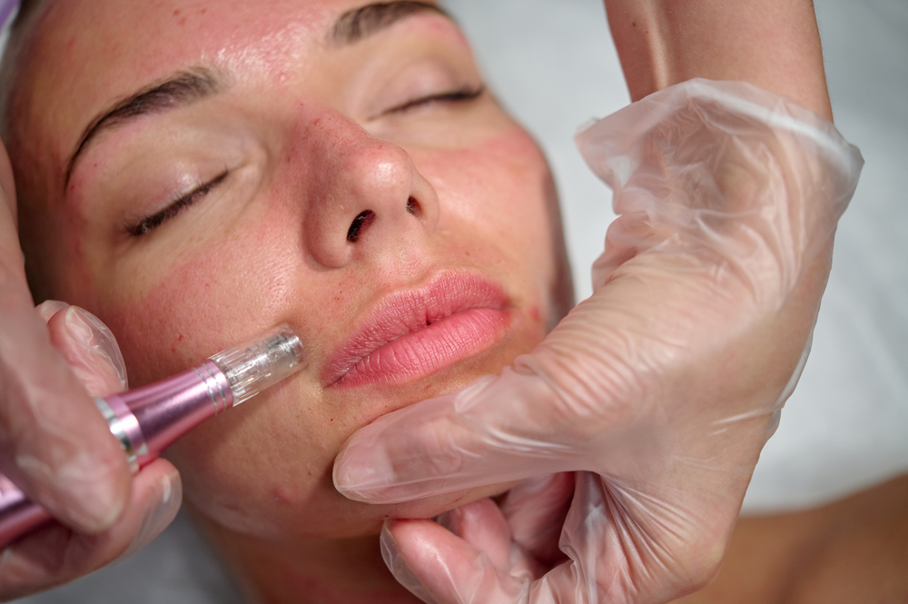 How Long Do Microneedling Treatments Last?