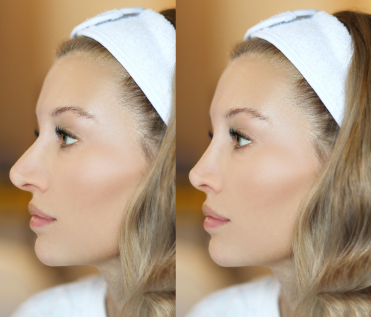 Nose Job Before and Afters Near McLean VA