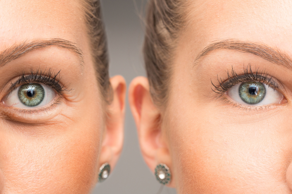 Top Surgeons in McLean Specializing in Eyelid Surgery