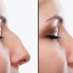 Functional and Cosmetic Benefits of a Nose Job in Sterling, VA