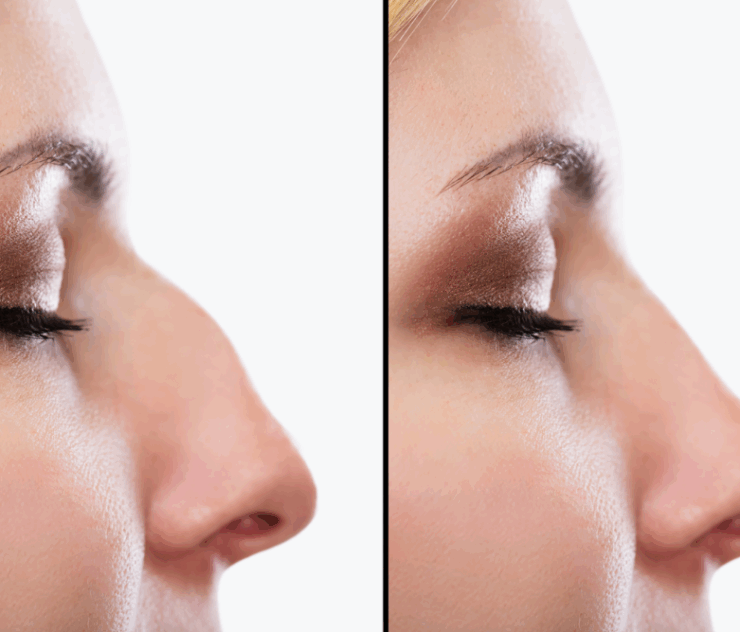 Functional and Cosmetic Benefits of a Nose Job in Sterling, VA
