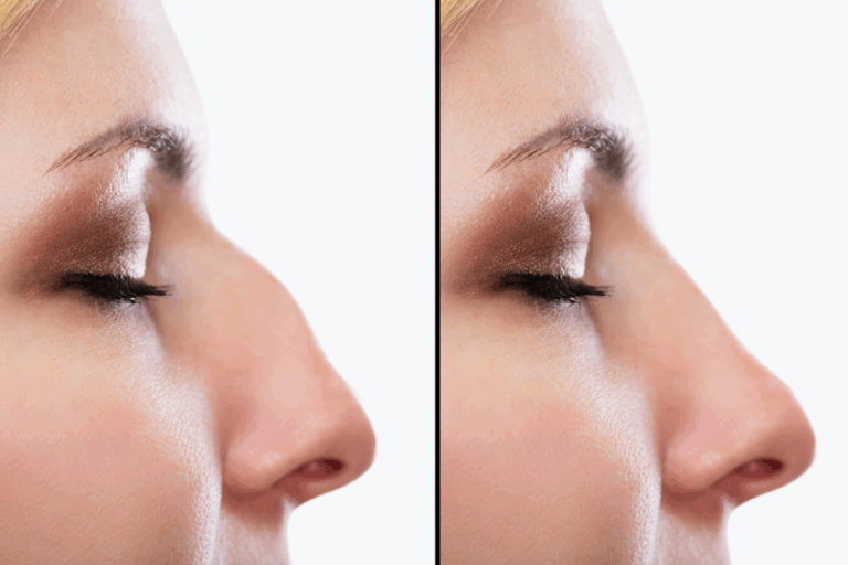Functional and Cosmetic Benefits of a Nose Job in Sterling, VA
