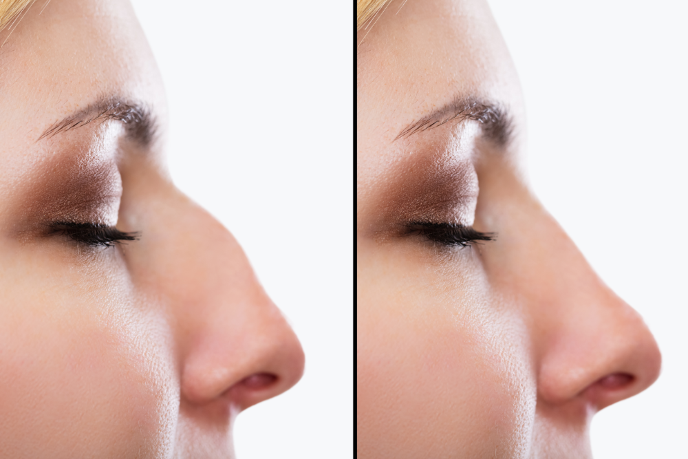 Functional and Cosmetic Benefits of a Nose Job in Sterling, VA
