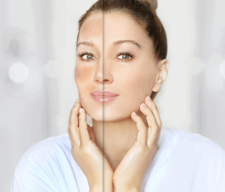 Anti-Aging Chemical Peels in McLean, VA