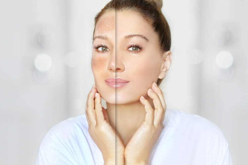 Anti-Aging Chemical Peels in McLean, VA