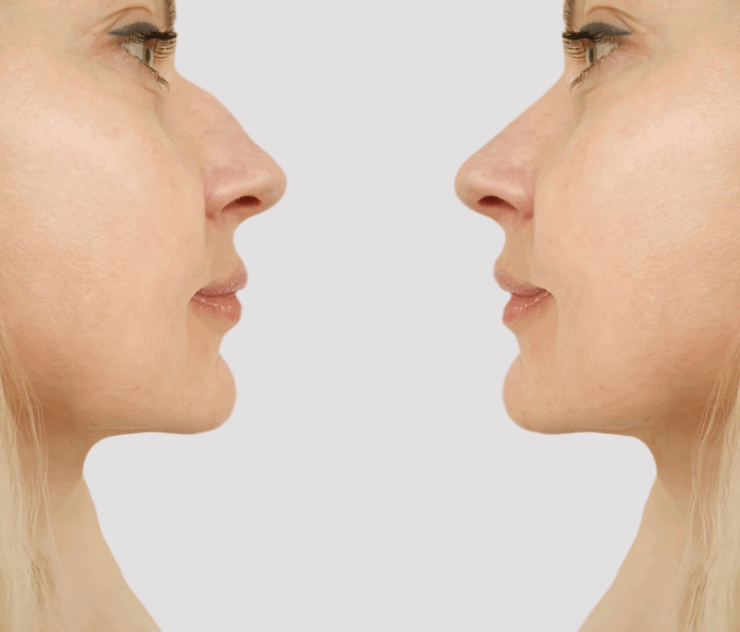 Best Rhinoplasty Clinics in South Riding, VA for Natural-Looking Results