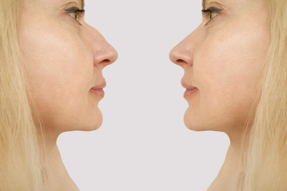 Best Rhinoplasty Clinics in South Riding, VA for Natural-Looking Results