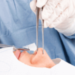 Revision Rhinoplasty in Ashburn, VA