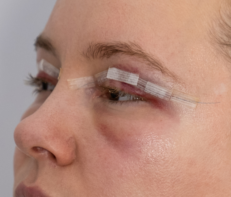 Best Eyelid Surgery Near Falls Church, Virginia