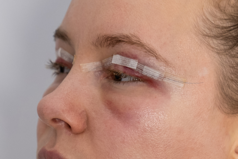 Best Eyelid Surgery Near Falls Church, Virginia