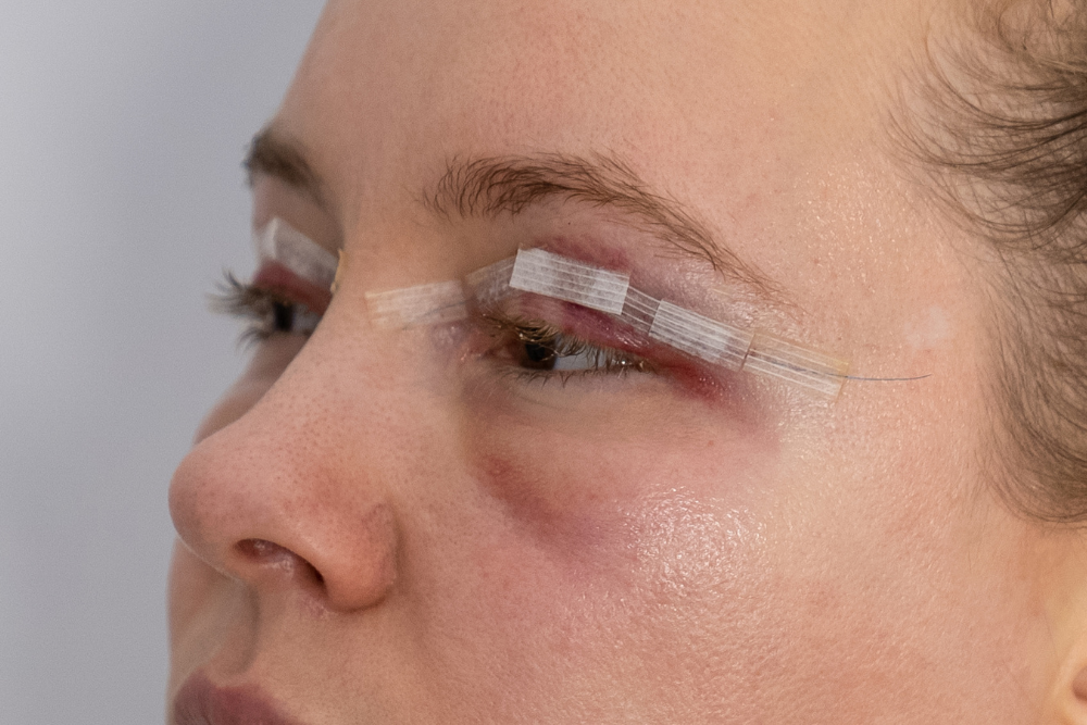 Best Eyelid Surgery Near Falls Church, Virginia