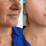 Natural-Looking Mini Facelift Results Near McLean, Virginia