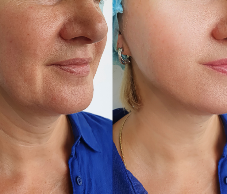 Natural-Looking Mini Facelift Results Near McLean, Virginia