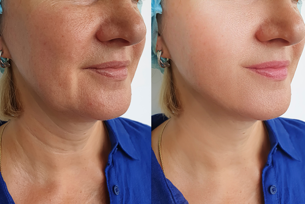 Natural-Looking Mini Facelift Results Near McLean, Virginia