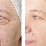 Deep Plane Facelift Cost in Northern Virginia