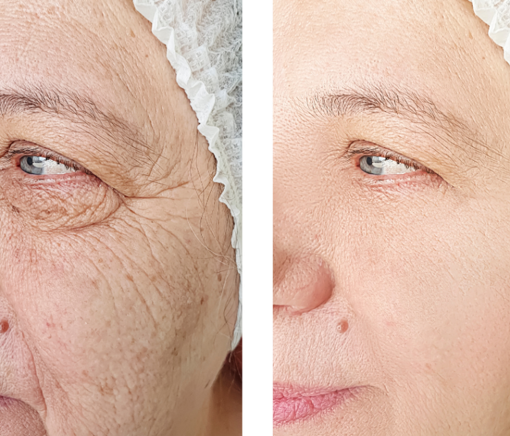 Deep Plane Facelift Cost in Northern Virginia