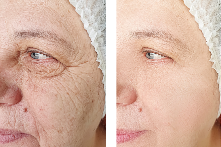 Deep Plane Facelift Cost in Northern Virginia