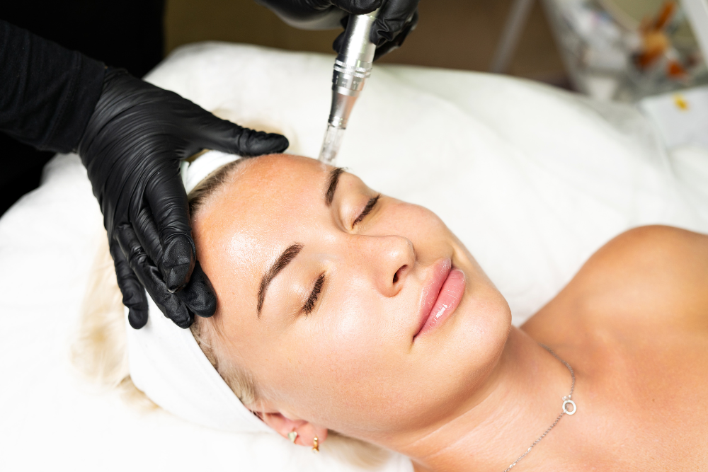 Microneedling Cost Near McLean, Virginia