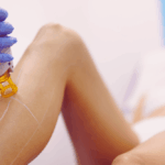 Laser Hair Removal Cost in McLean VA