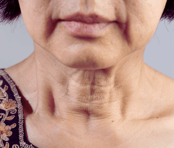 Neck Lift Surgery Near Ashburn Virginia