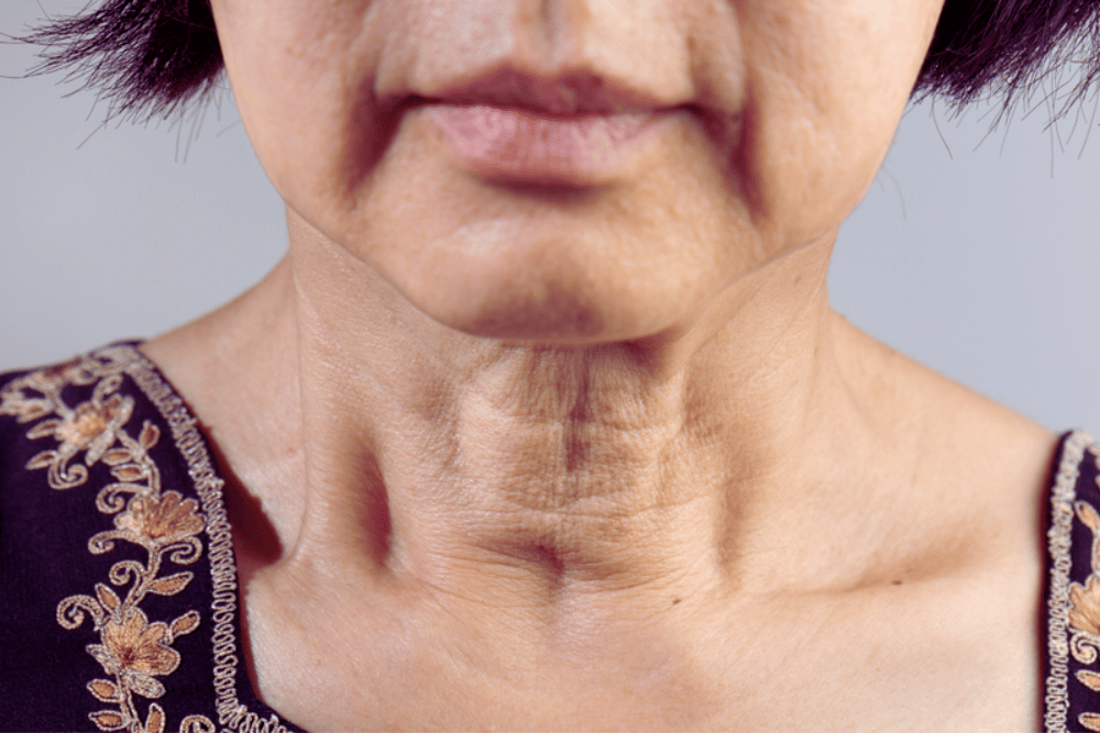 Neck Lift Surgery Near Ashburn Virginia