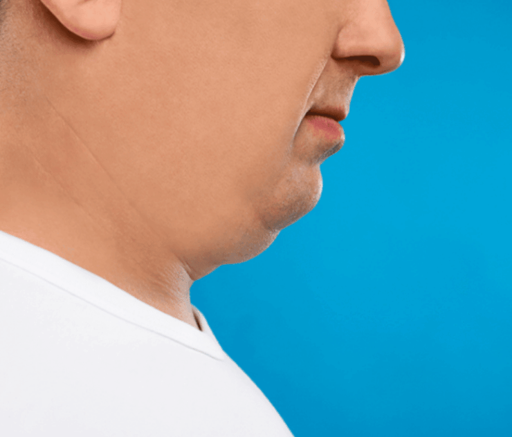 Chin Liposuction in Reston Virginia