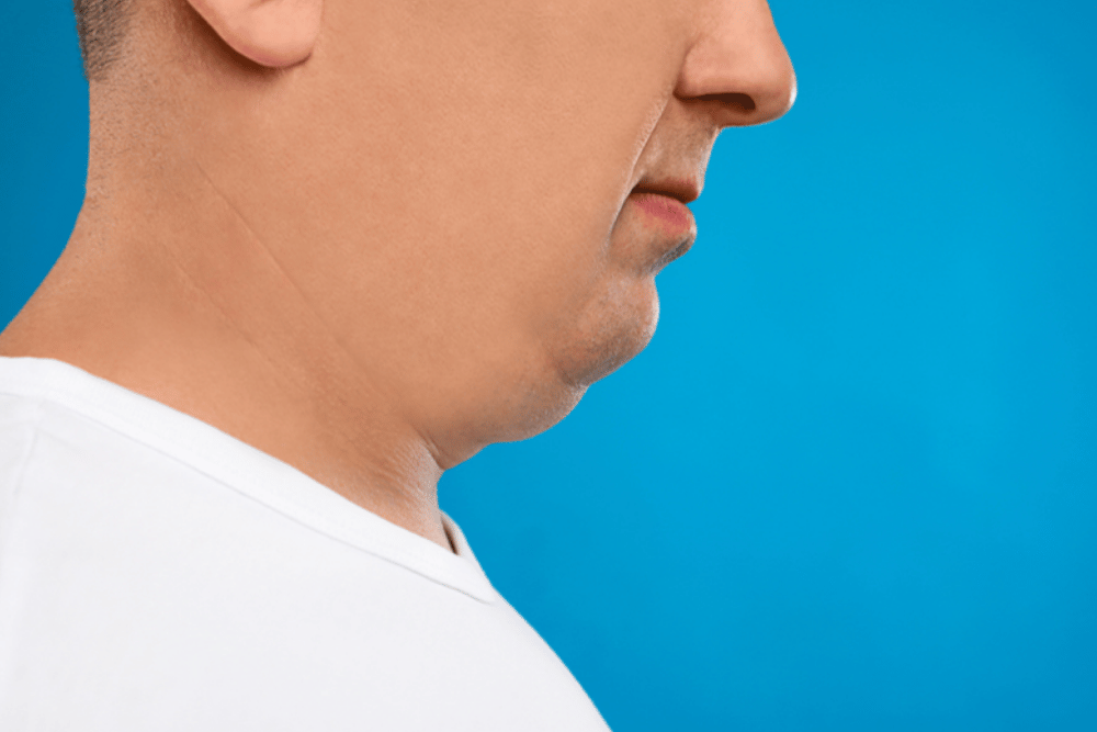 Chin Liposuction in Reston Virginia
