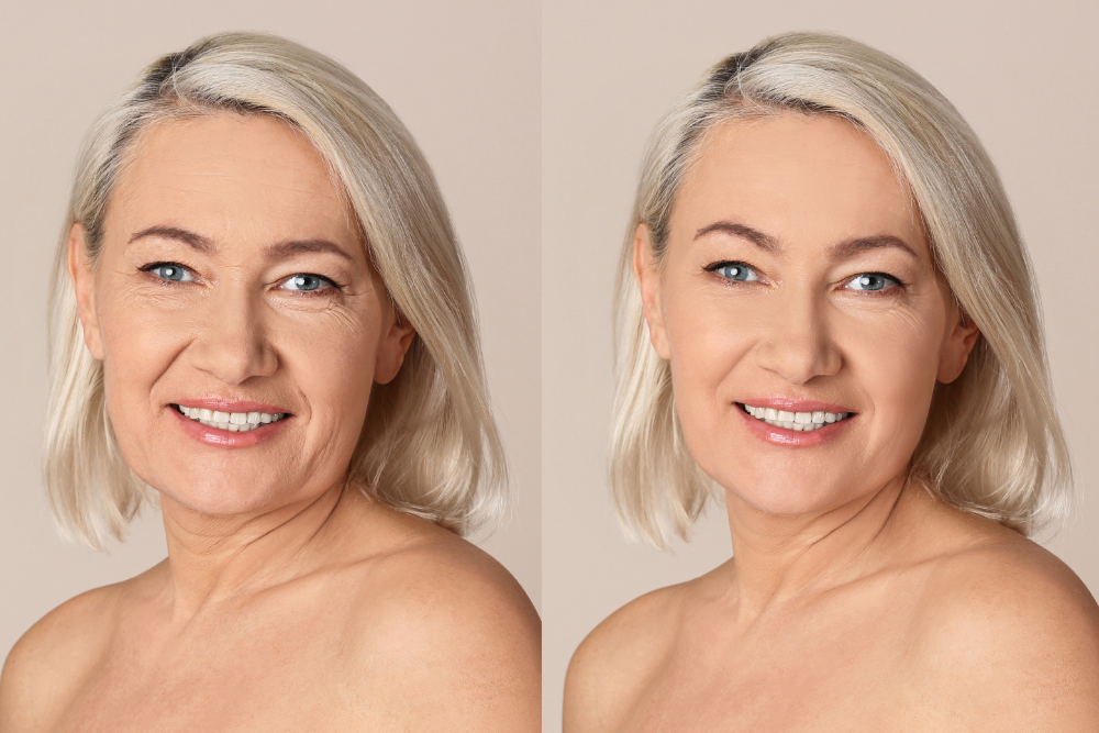 Deep Plane Facelift Results in Vienna, VA