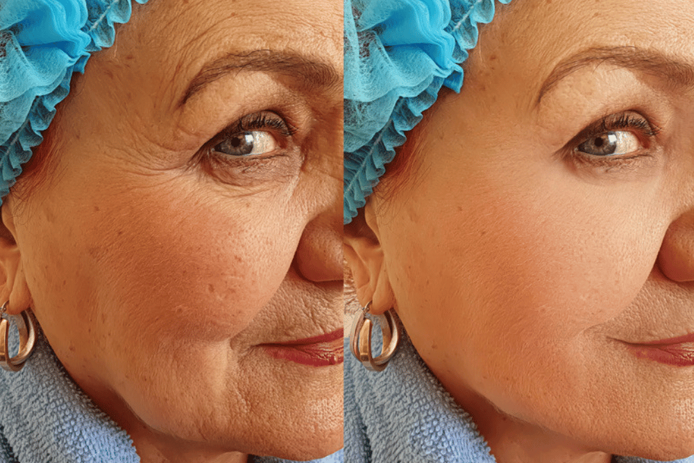 Deep Plane Facelift Recovery Guide in Leesburg VA