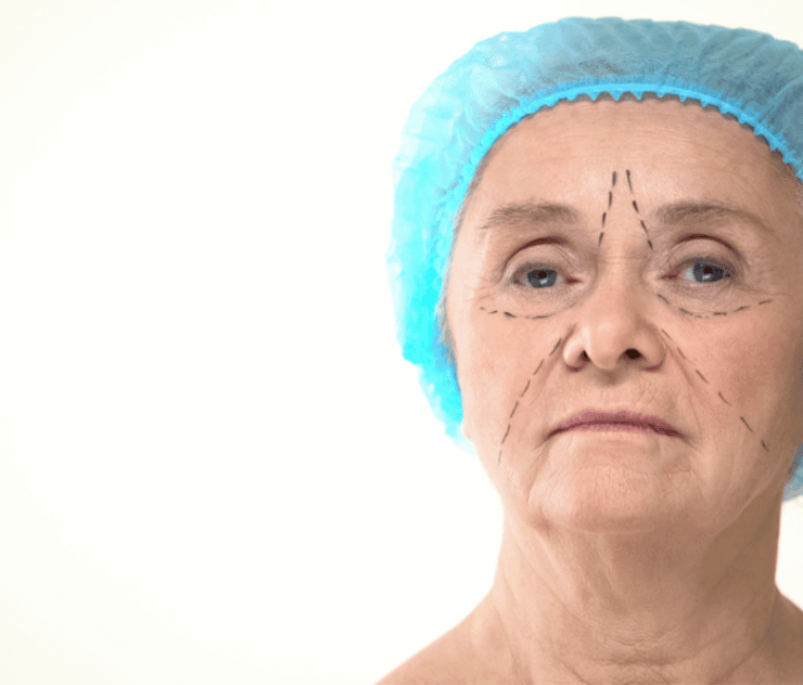 Deep Plane Facelift Specialist in Fairfax VA